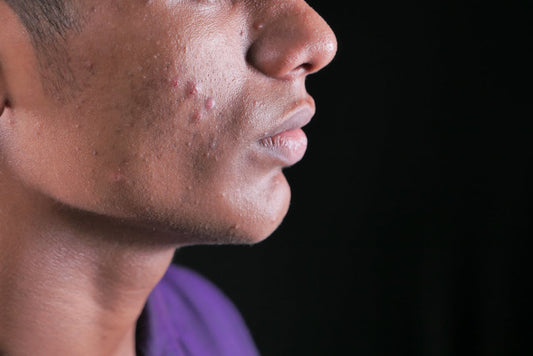 Las Múltiples Caras del Ácido Salicílico en el Tratamiento Médico